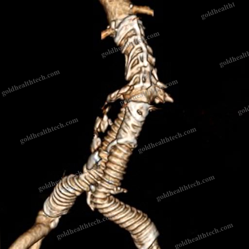 Abdominal Aorta Stent Graft
