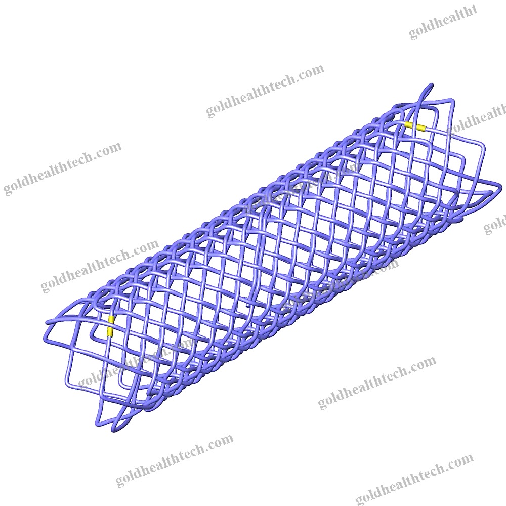 Tracheal Stent