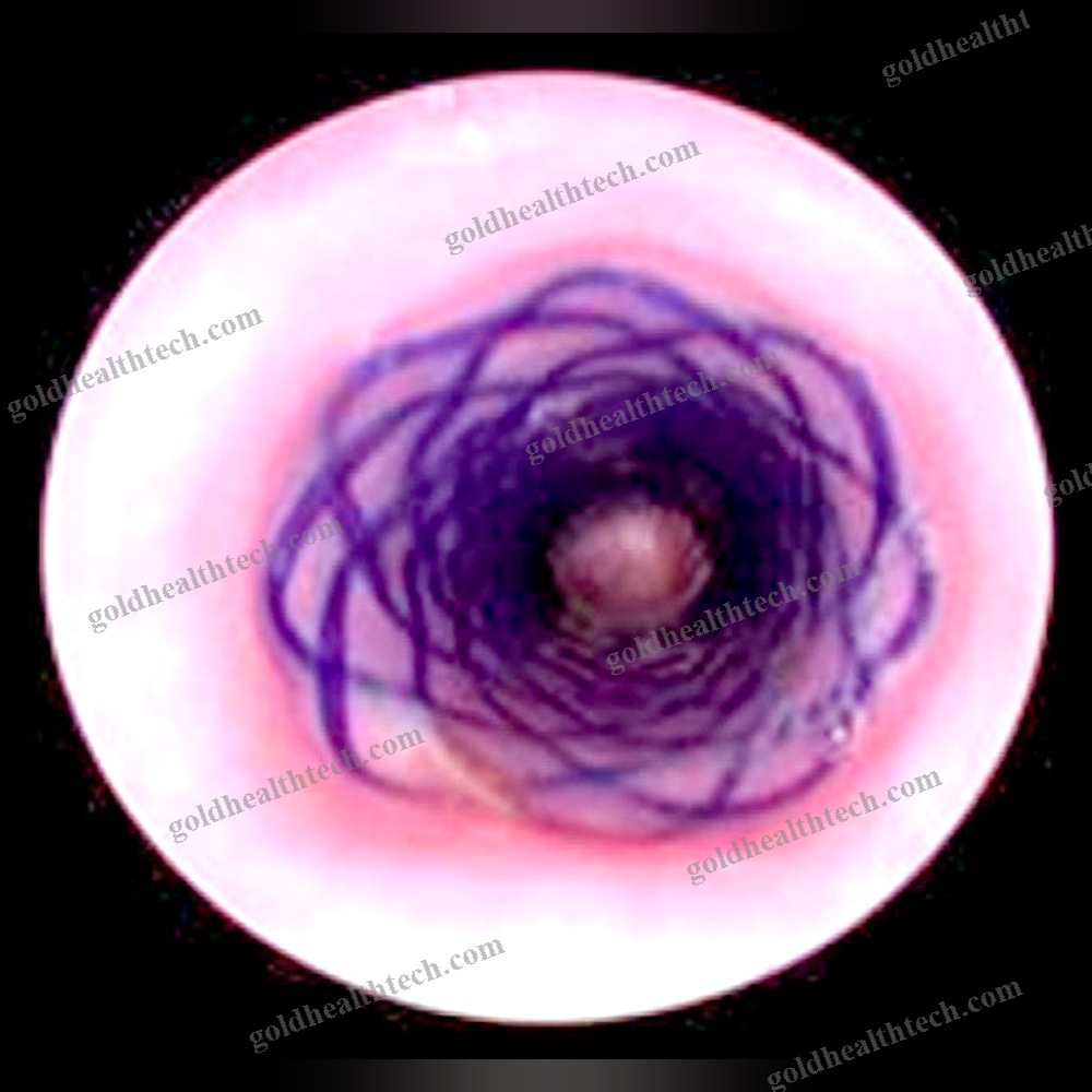 Tracheal Stent