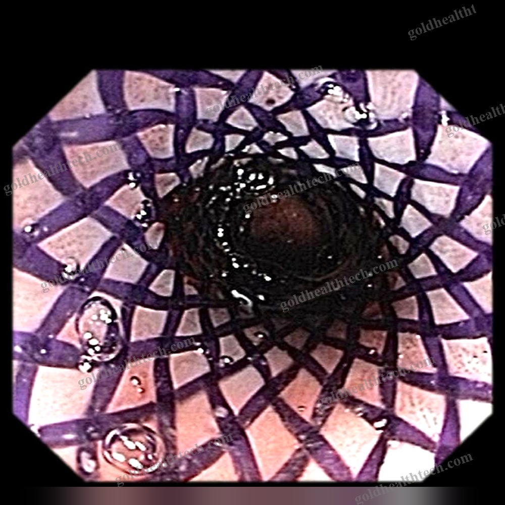Esophageal Stent