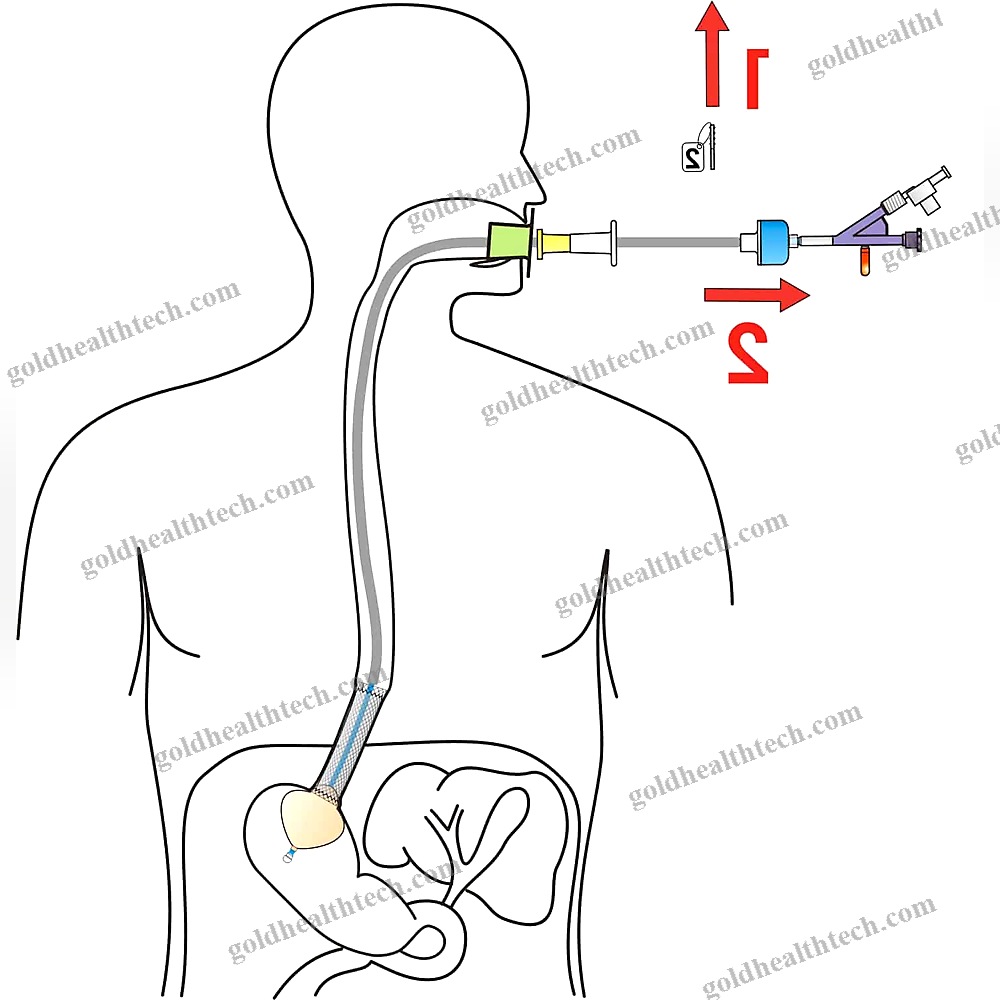 Esophageal Stent