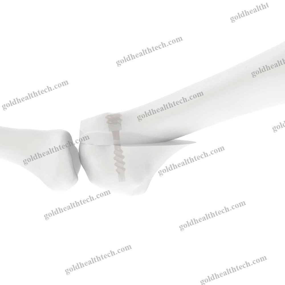 Forefoot Osteotomy Screw