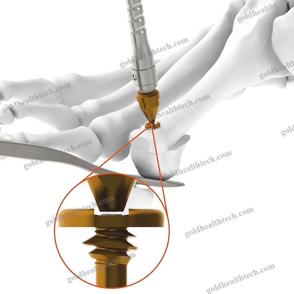 Forefoot Osteotomy Screw