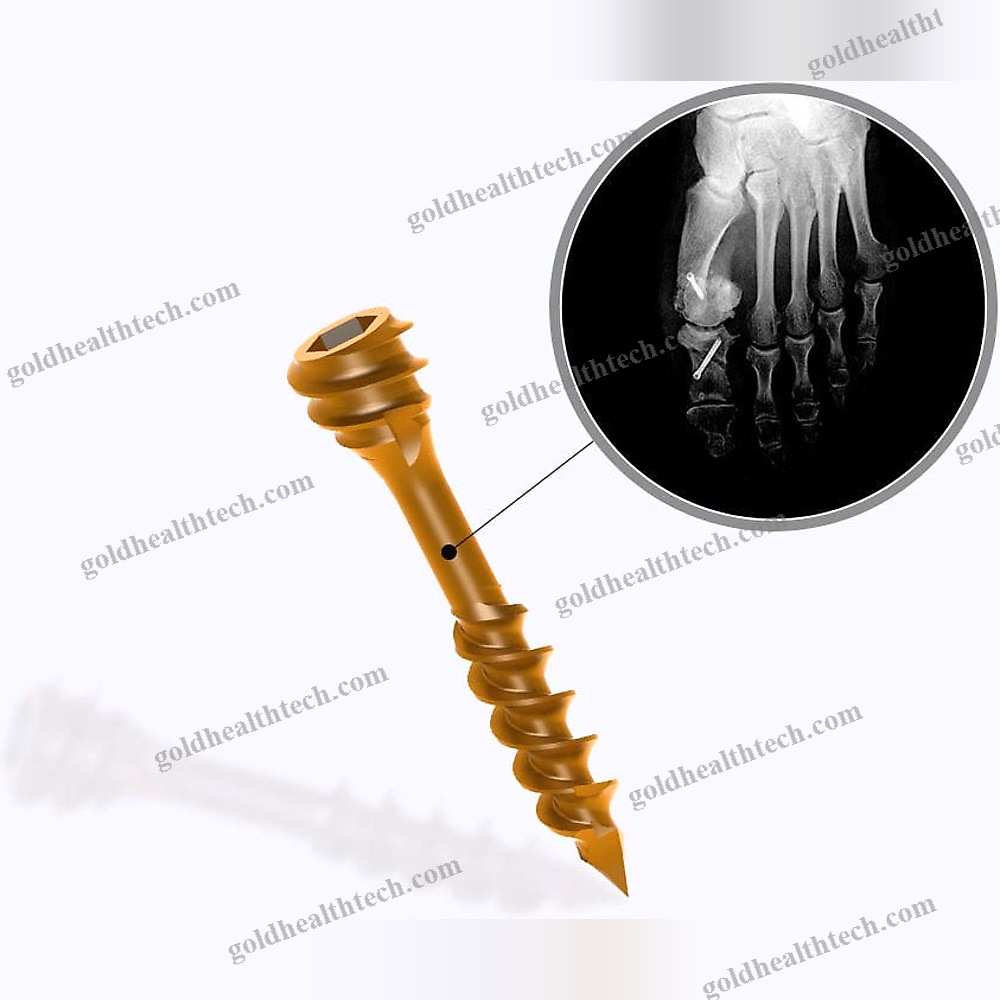 Forefoot Osteotomy Screw