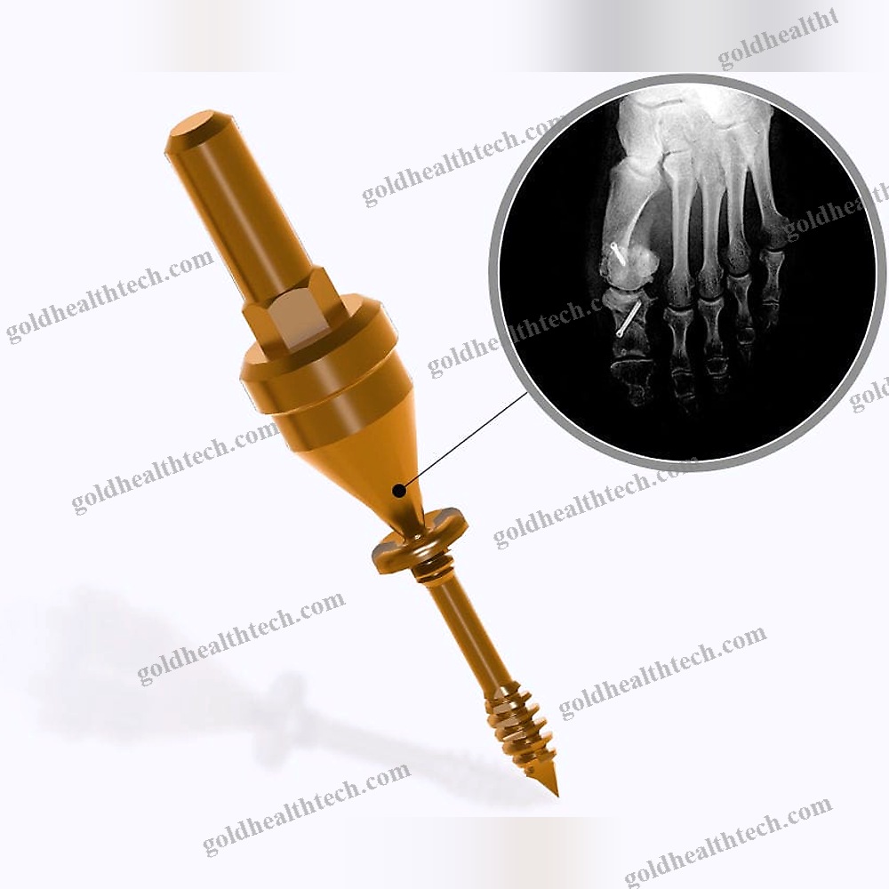 Forefoot Osteotomy Screw