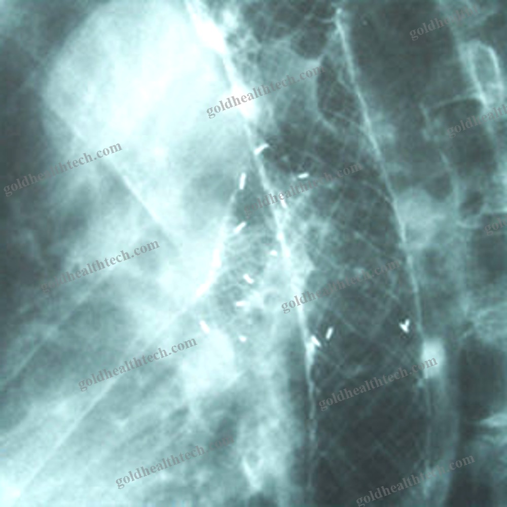 Tracheal Stent