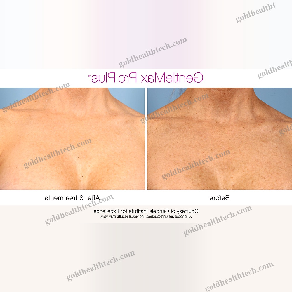 Pigmented Lesion Treatment Laser