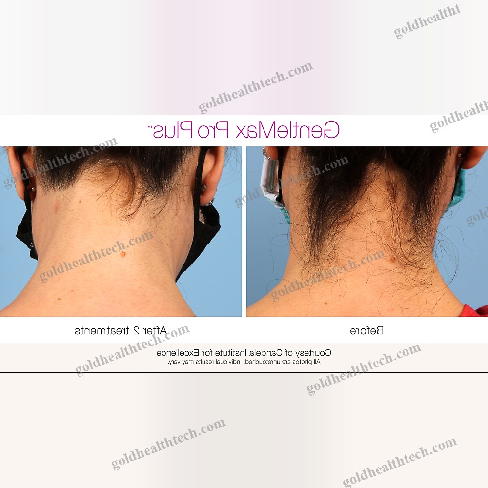 Pigmented Lesion Treatment Laser