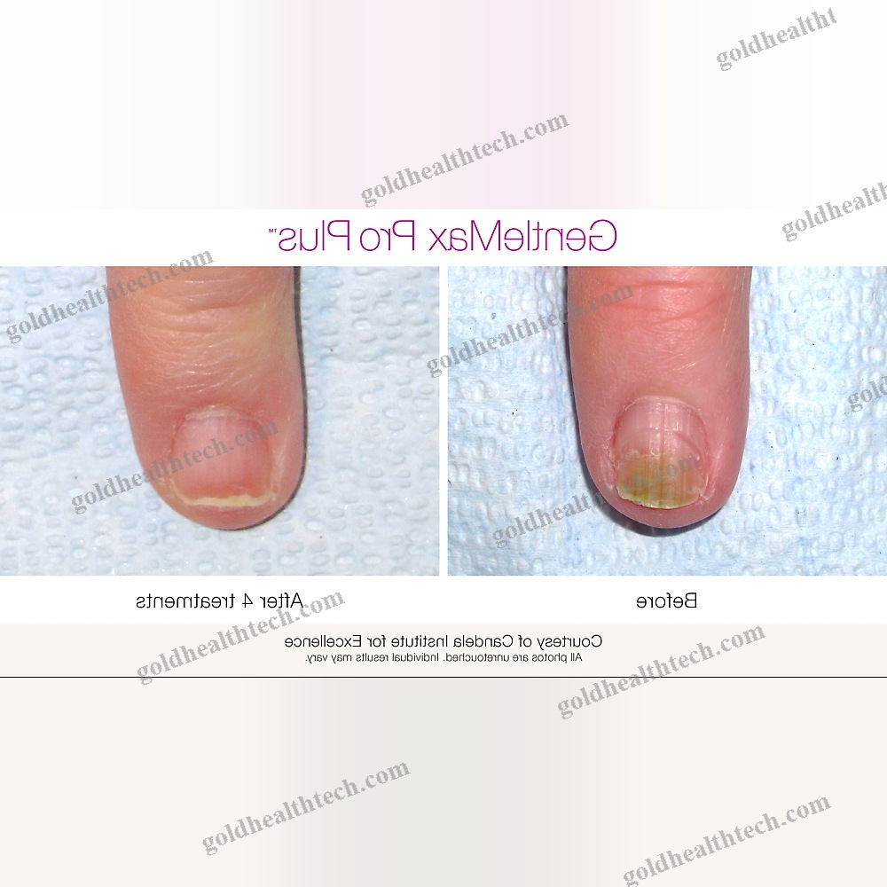 Pigmented Lesion Treatment Laser