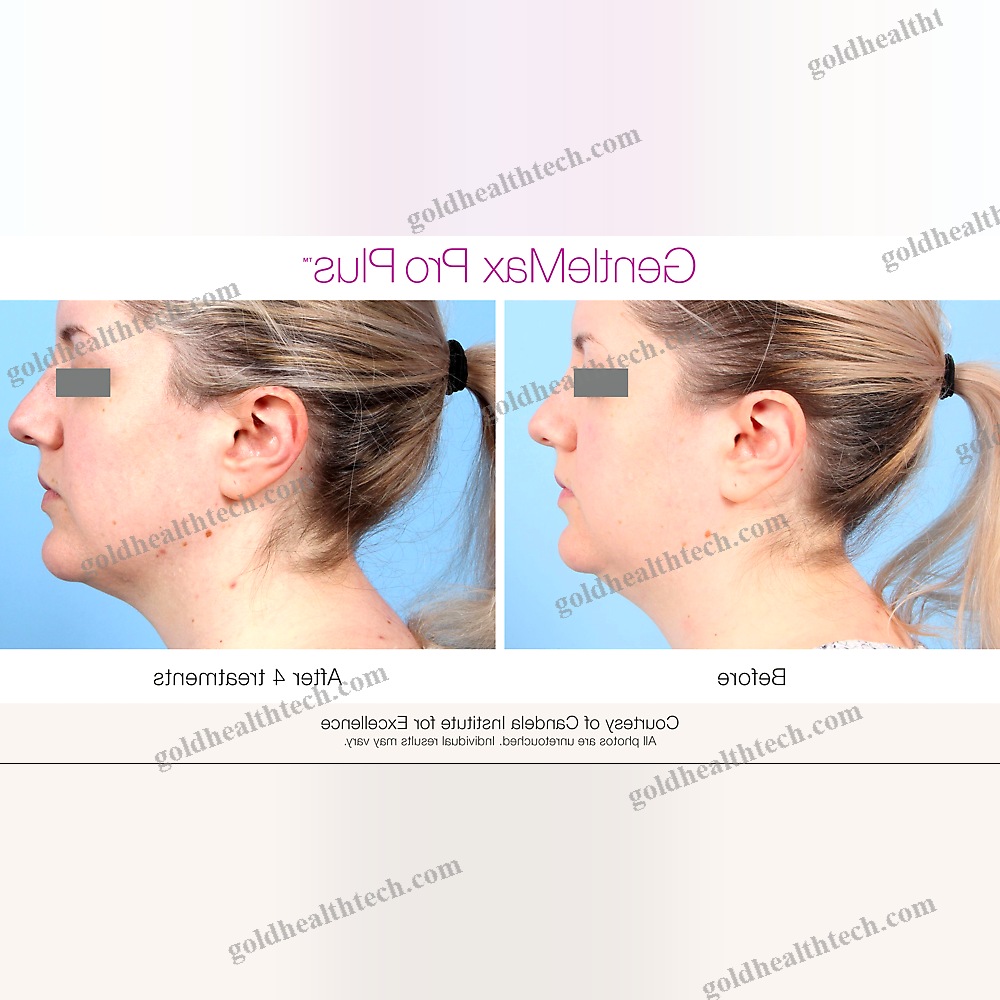 Pigmented Lesion Treatment Laser