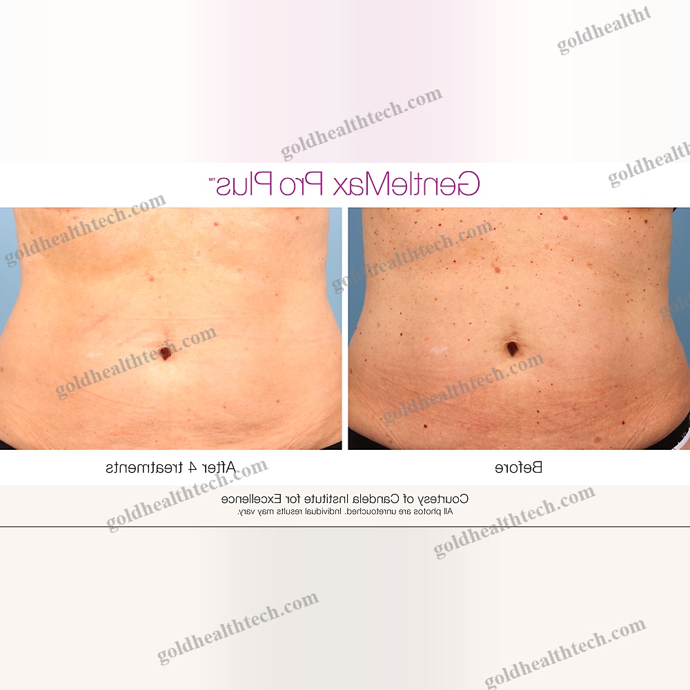 Pigmented Lesion Treatment Laser