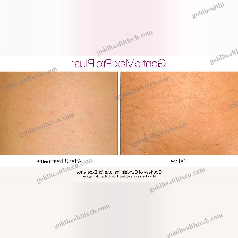 Pigmented Lesion Treatment Laser