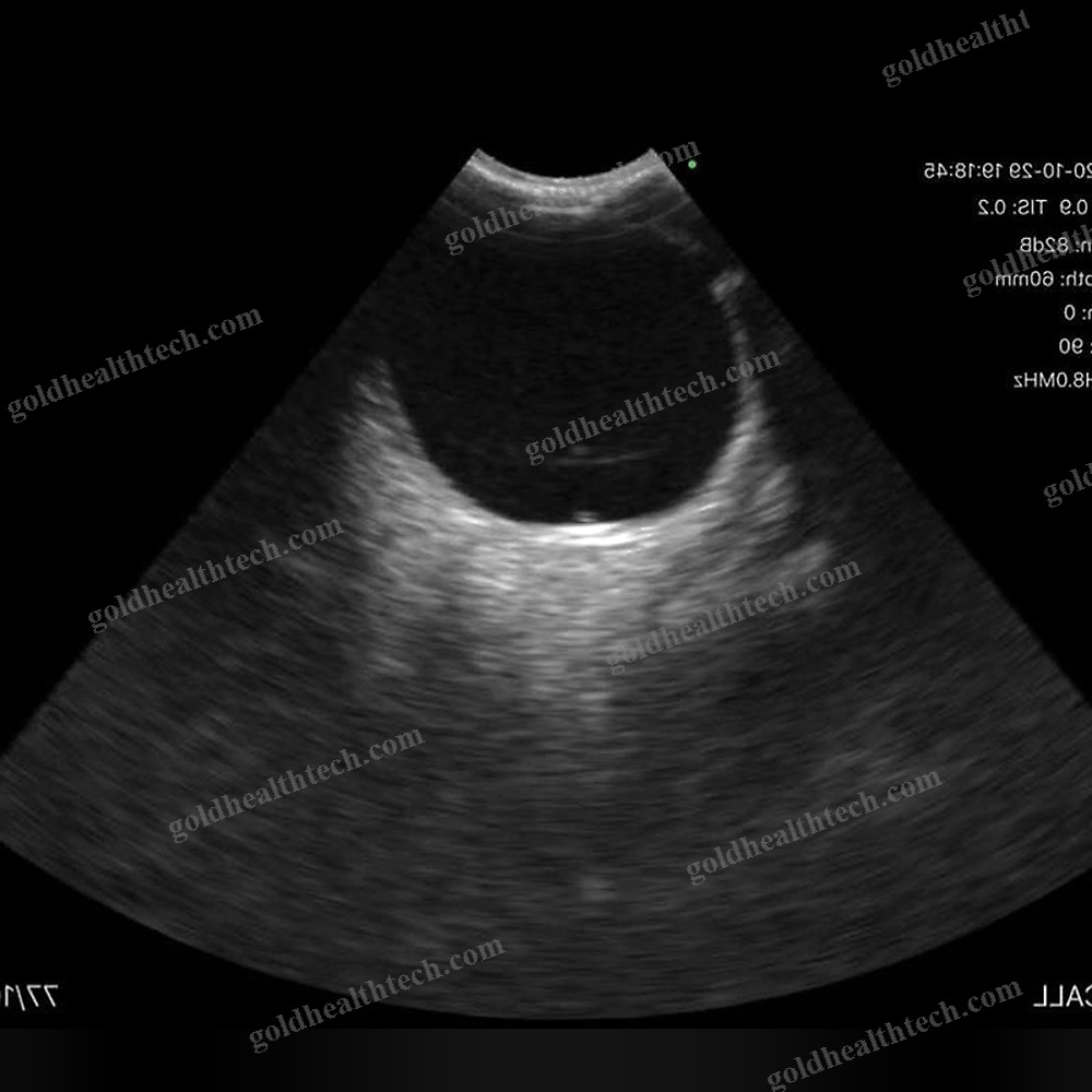 Hand-Held Ultrasound System