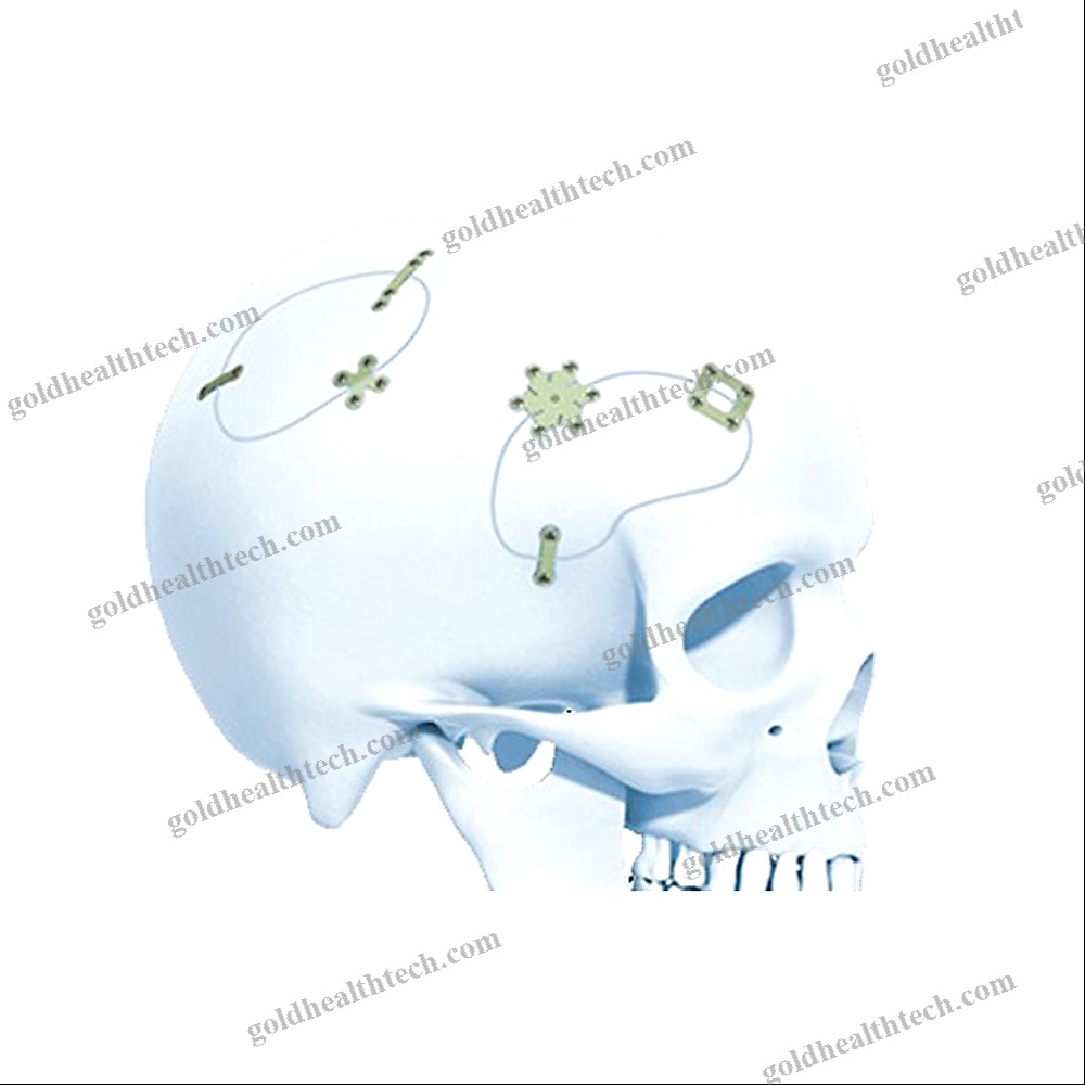 Non-Absorbable Cranial Fixation System