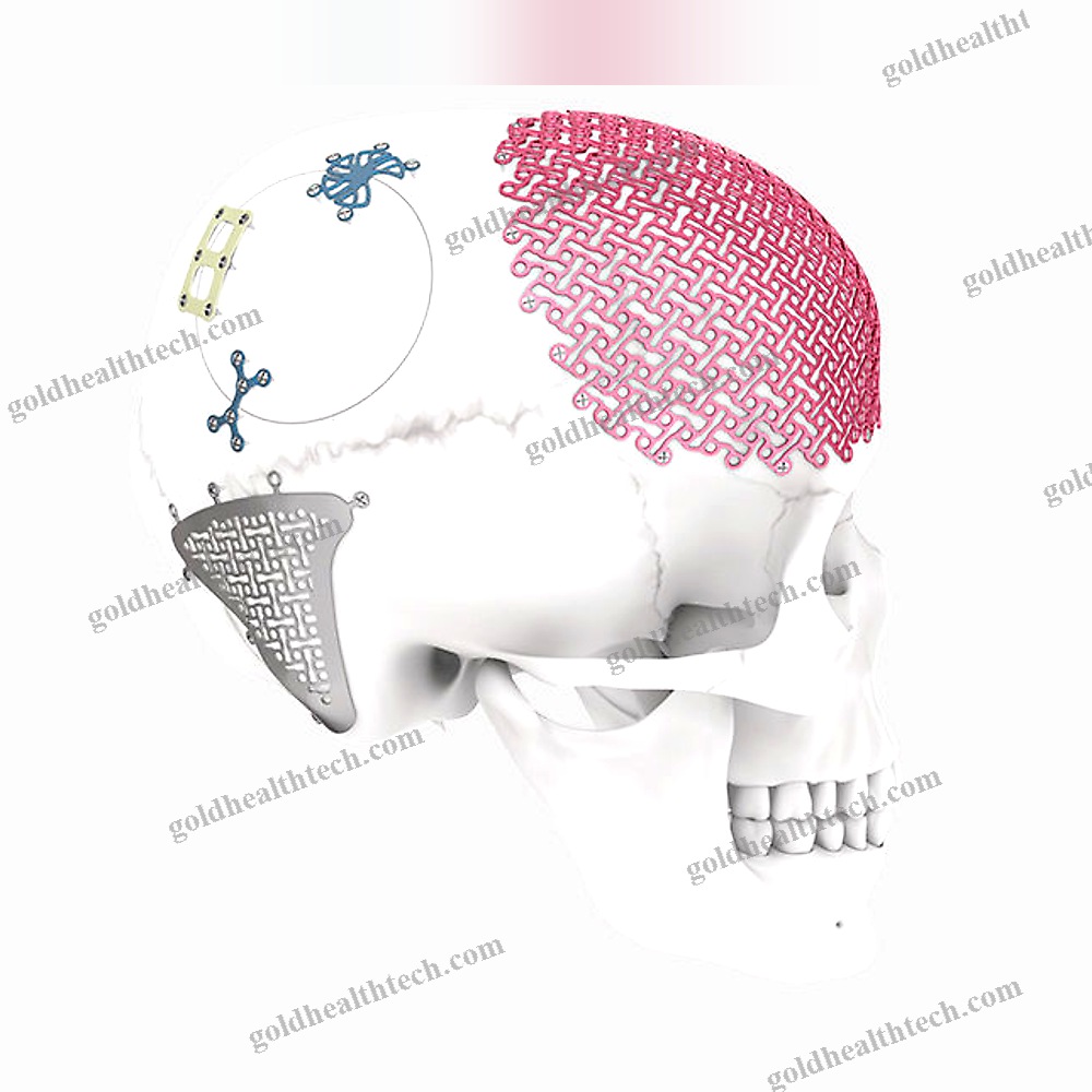 Non-Absorbable Cranial Fixation System