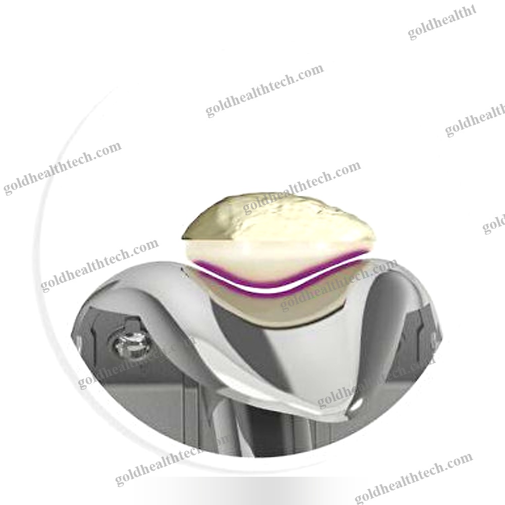 Total Knee Prosthesis