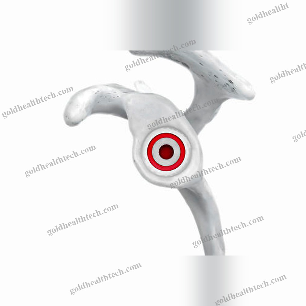 Cementless Shoulder Prosthesis