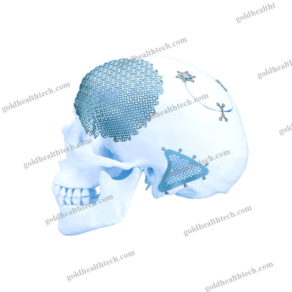 Non-Absorbable Cranial Fixation System