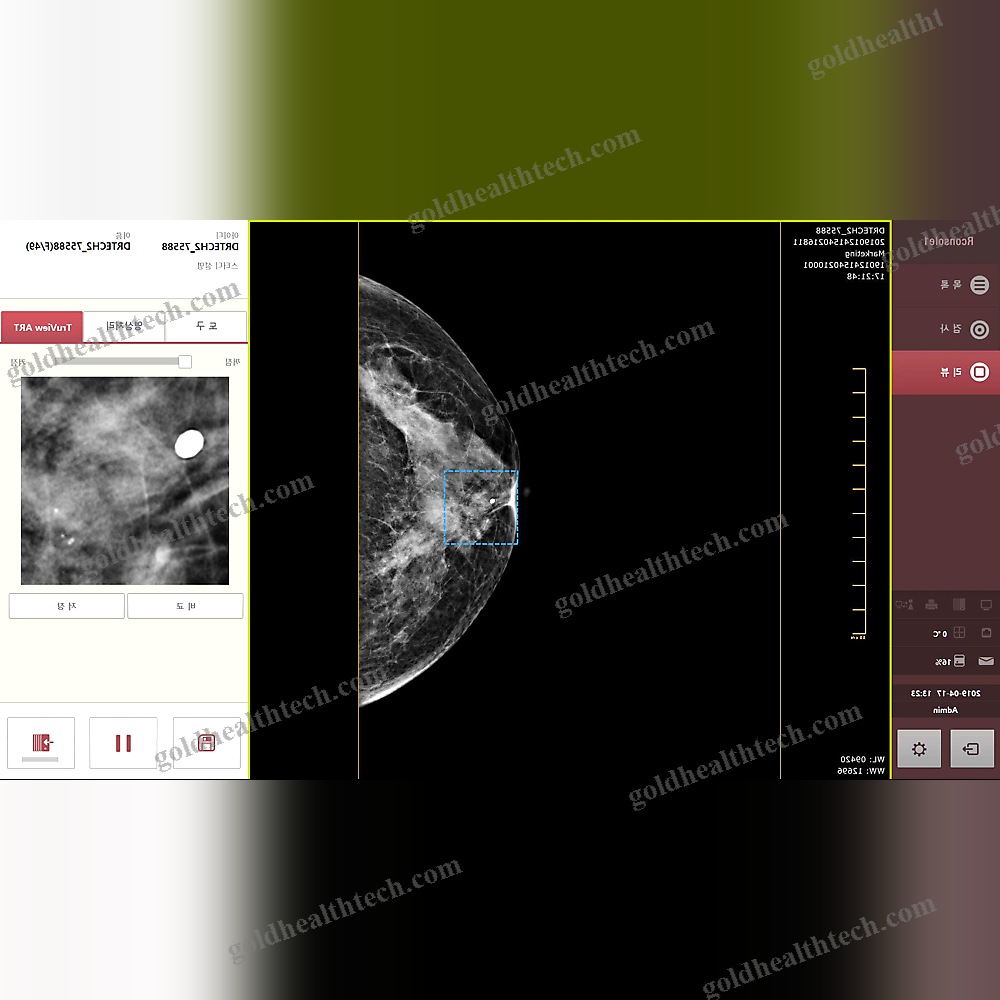 Mammography Software