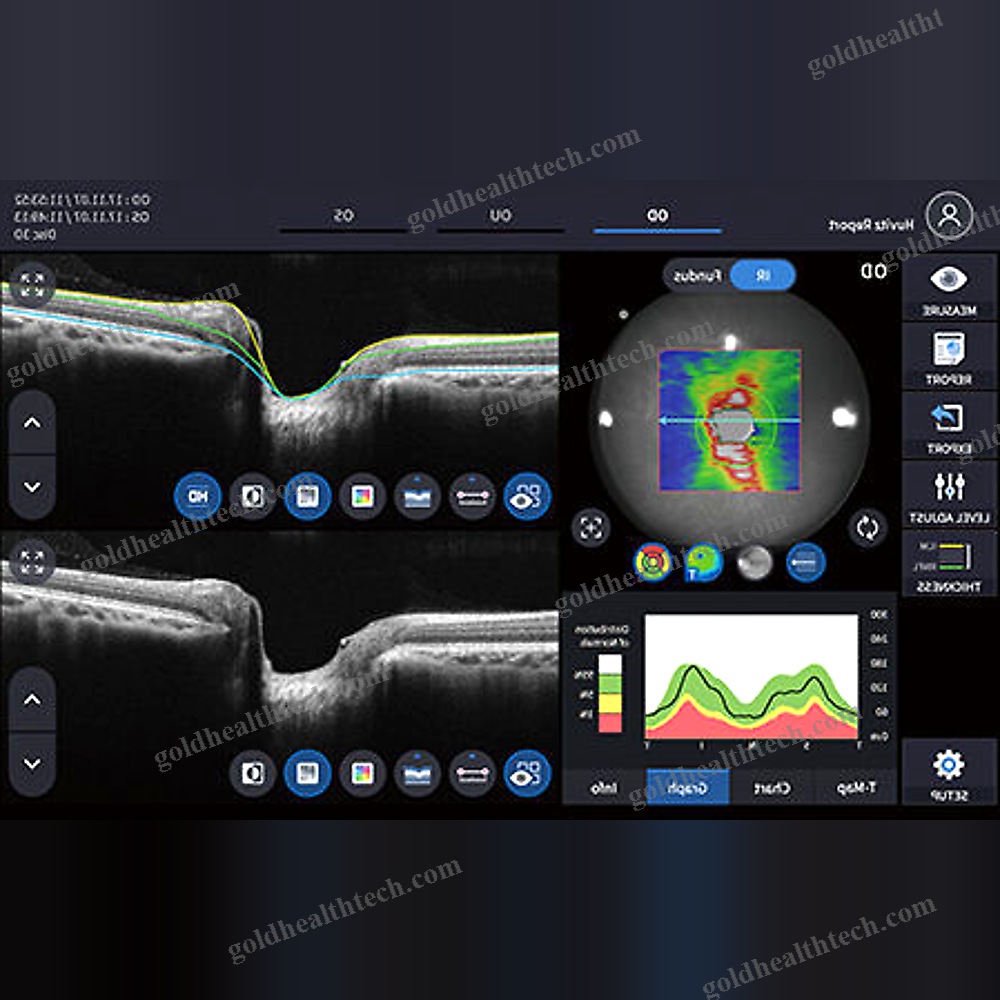 Oct Ophthalmoscope