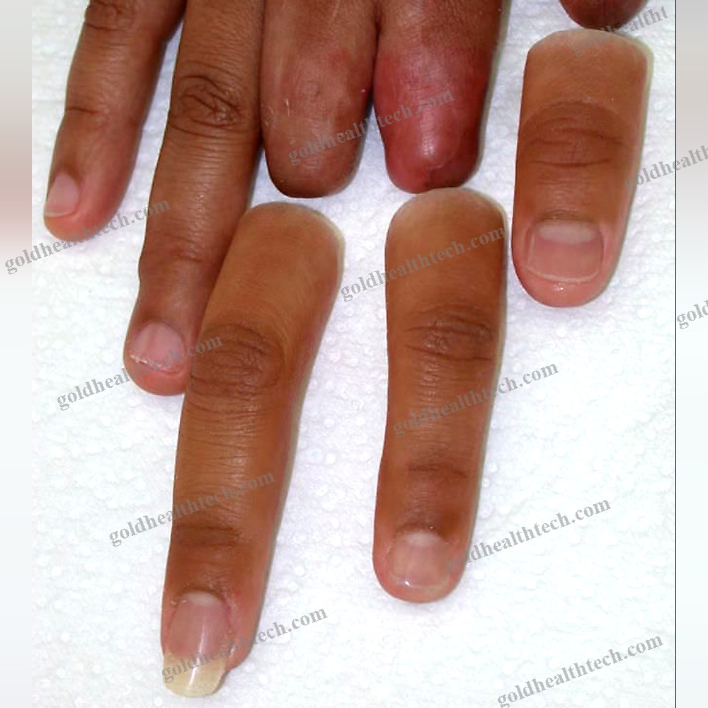 Finger Cosmetic Prosthesis