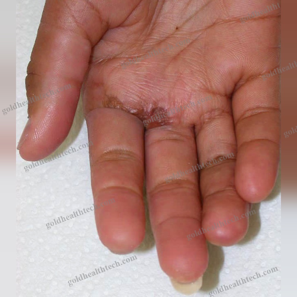 Finger Cosmetic Prosthesis