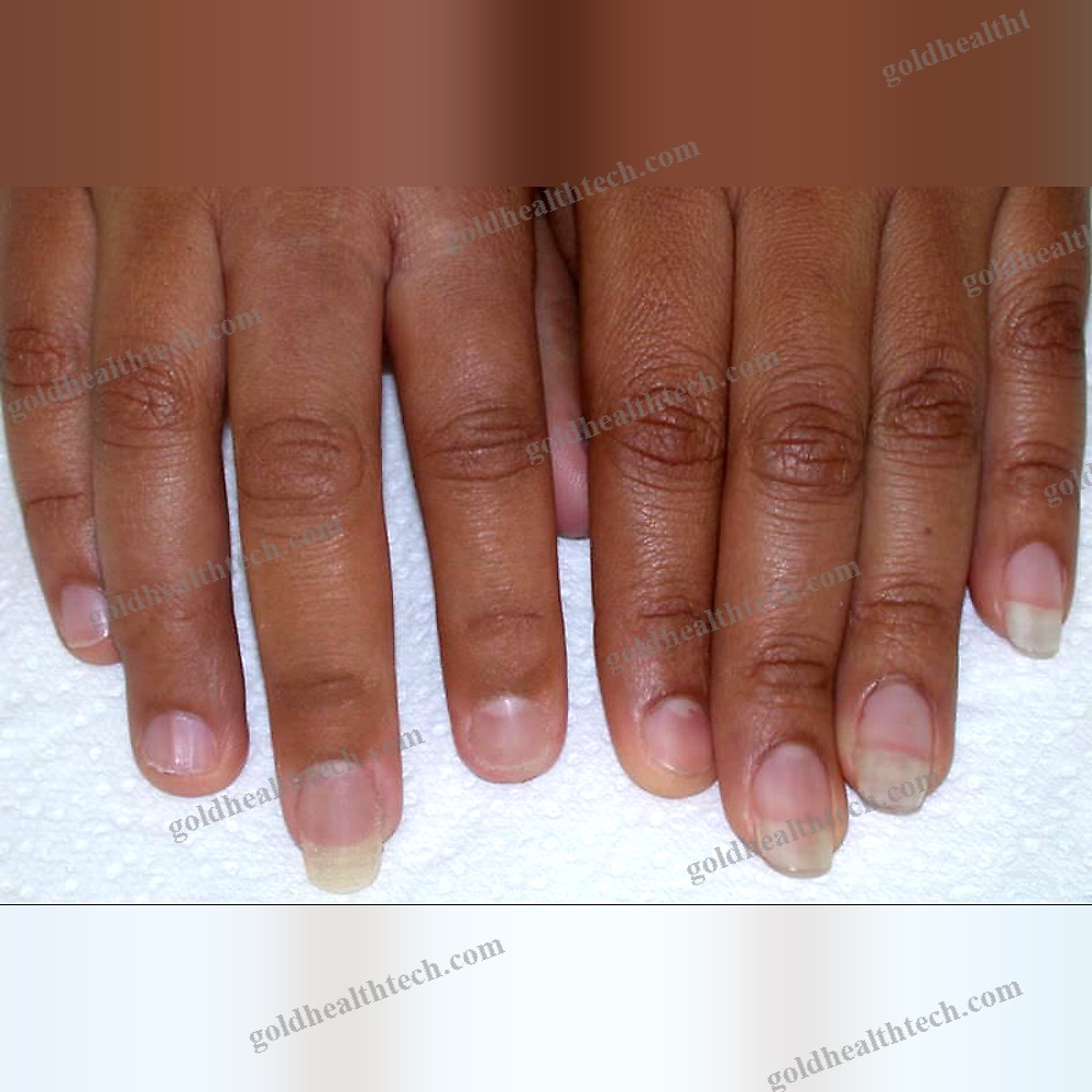 Finger Cosmetic Prosthesis