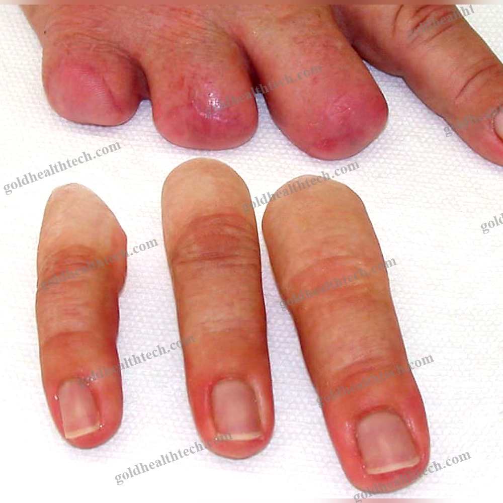 Finger Cosmetic Prosthesis