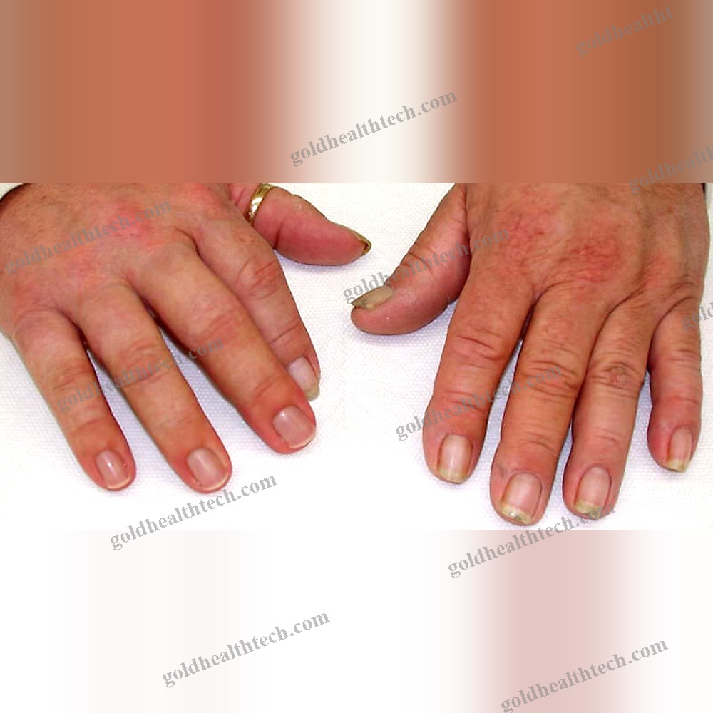 Finger Cosmetic Prosthesis