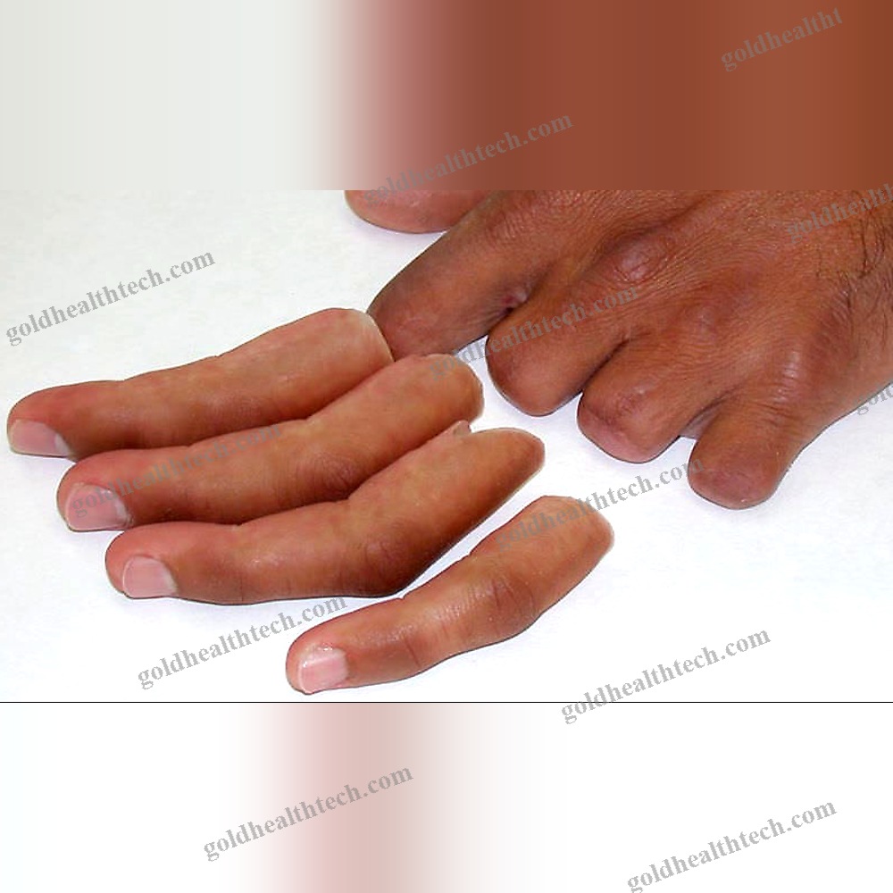 Finger Cosmetic Prosthesis