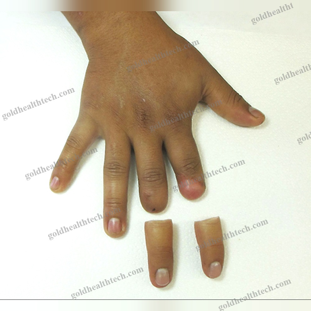Finger Cosmetic Prosthesis