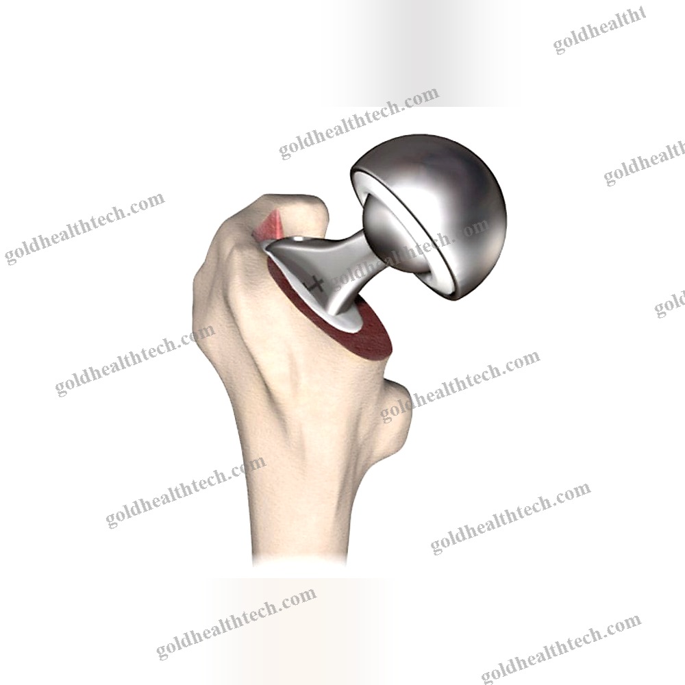 Femoral Head Prosthesis