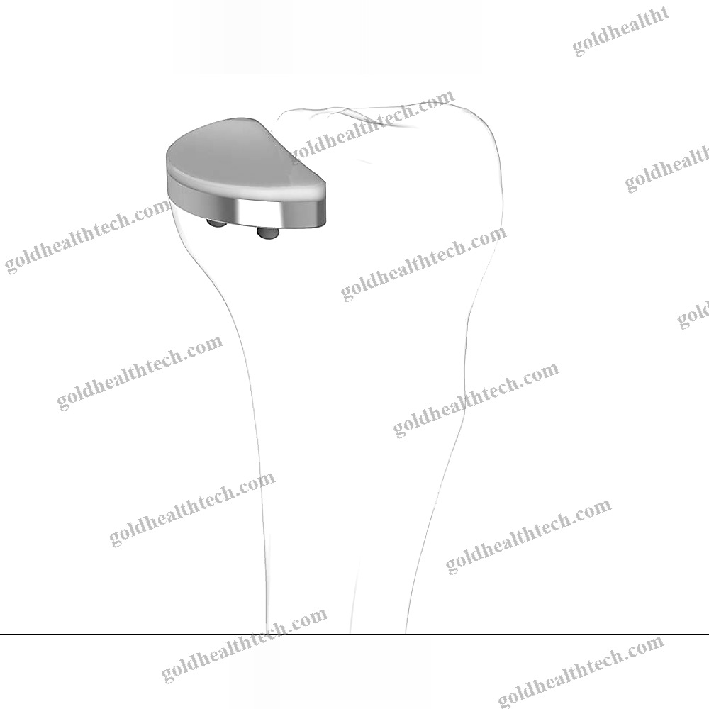 Unicompartmental Knee Prosthesis