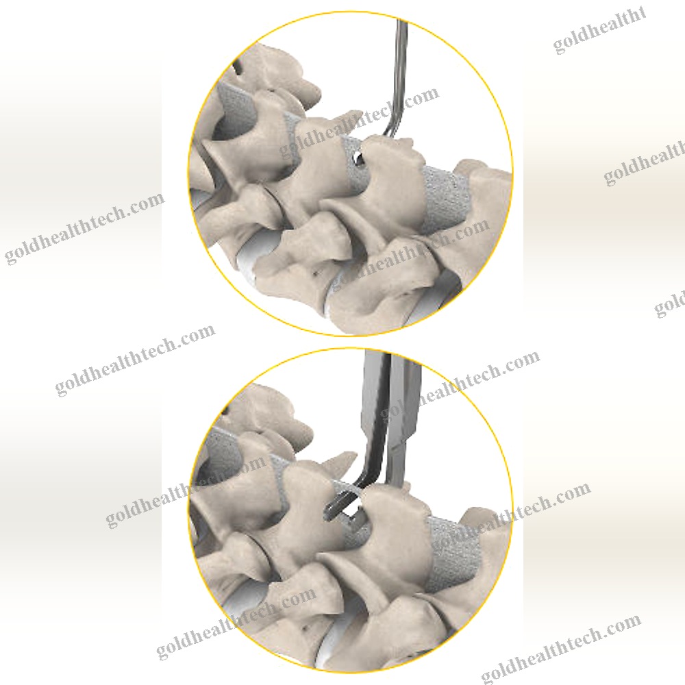 Lumbar Interspinous Vertebral Implant