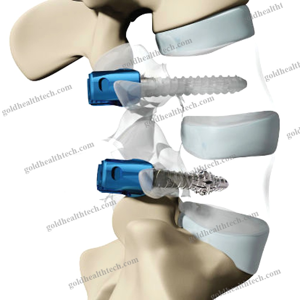 Thoracic-Lumbar Vertebra Pedicle Screw