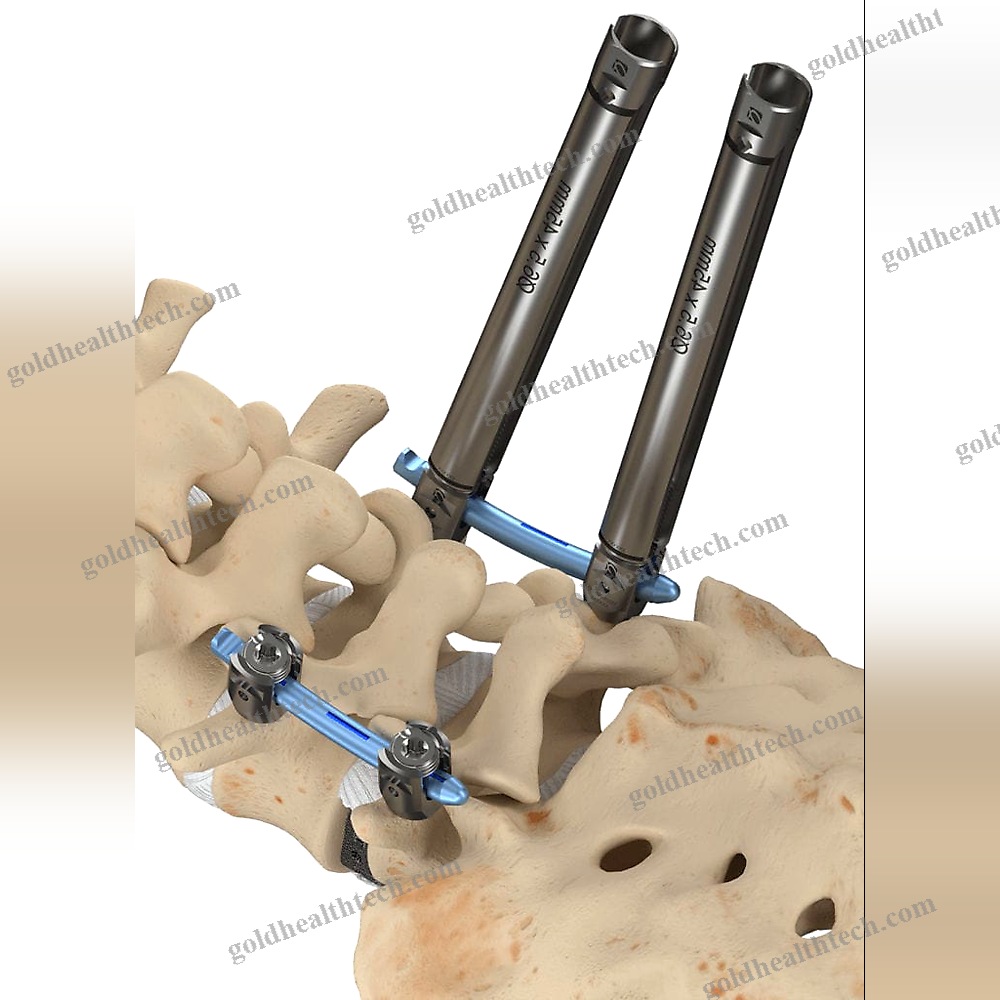 Minimally Invasive Pedicle Screw Positioning System