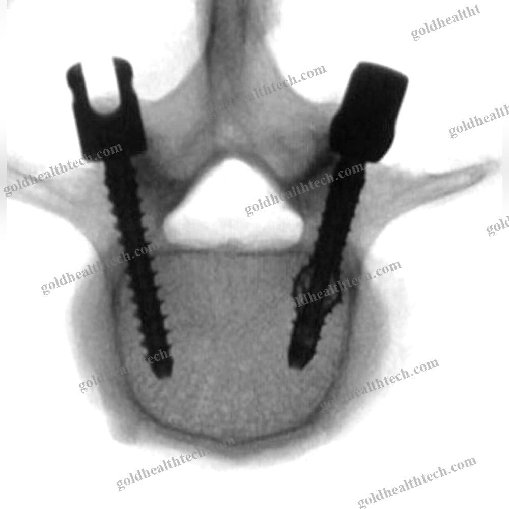 Thoracic-Lumbar Vertebra Pedicle Screw