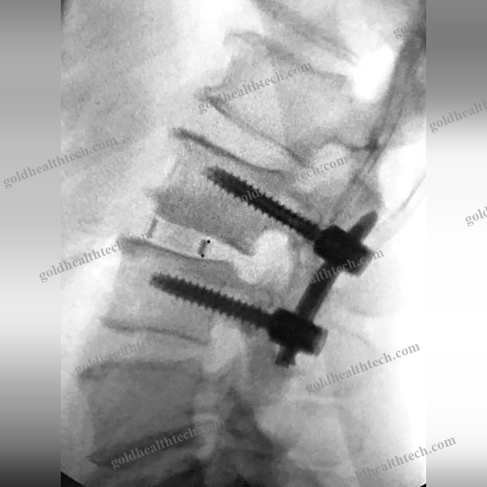 Minimally Invasive Pedicle Screw Positioning System