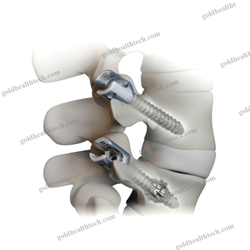 Thoracic-Lumbar Vertebra Pedicle Screw