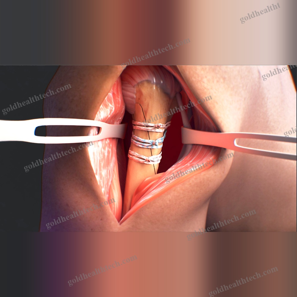 Periprosthetic Fracture Bone Cerclage Wiring