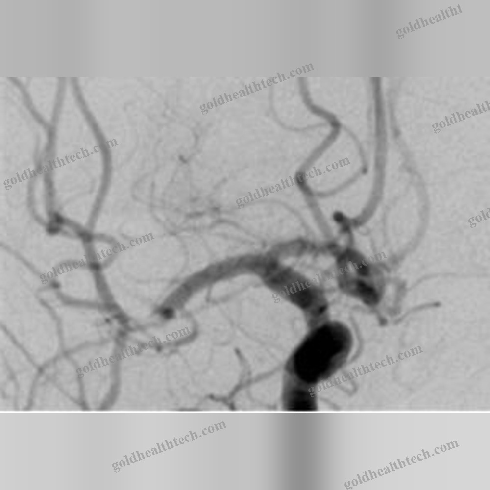 Thrombectomy Catheter