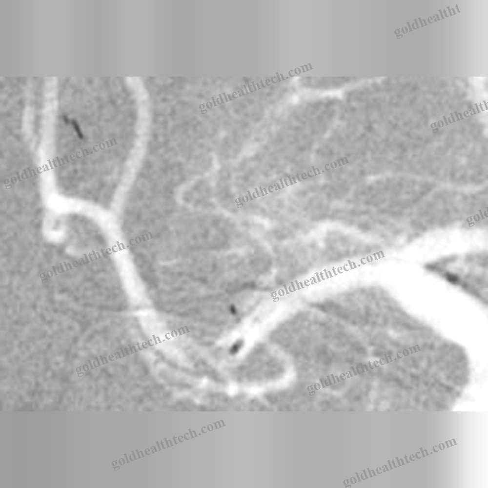Thrombectomy Catheter
