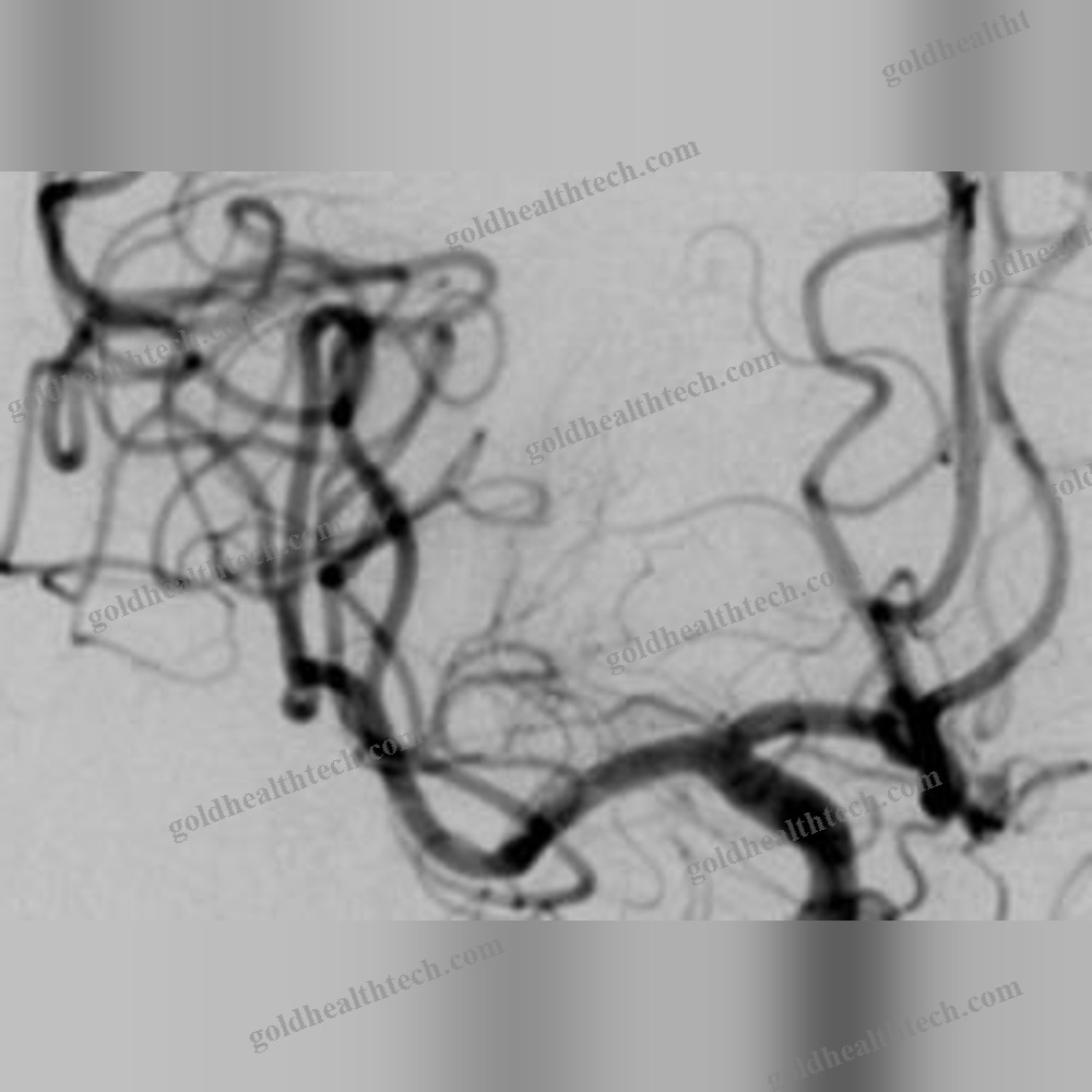 Thrombectomy Catheter