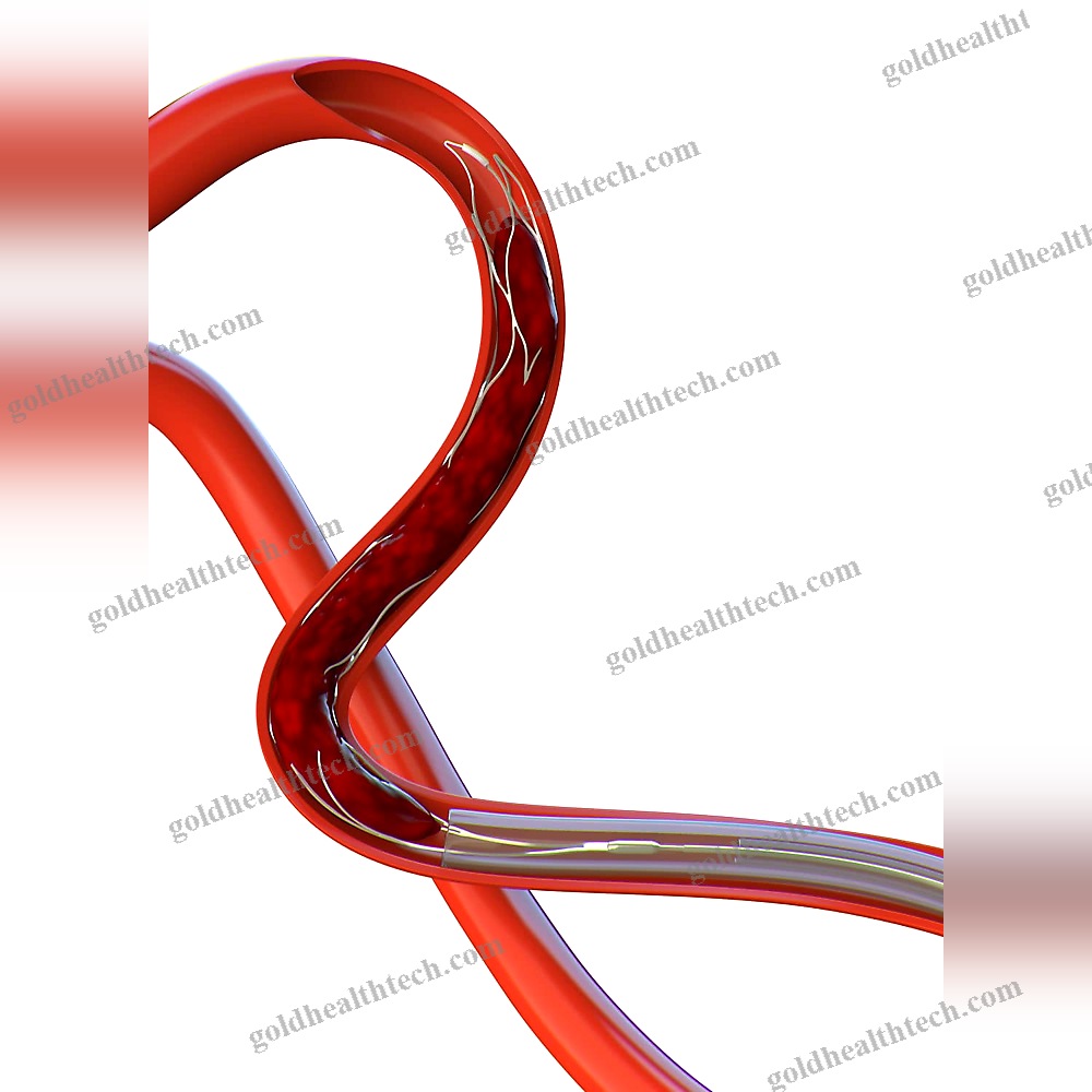 Thrombectomy Catheter
