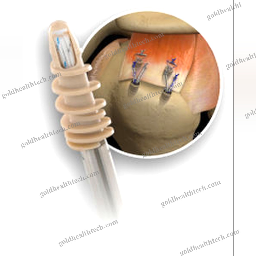 Small Joint Suture Anchor