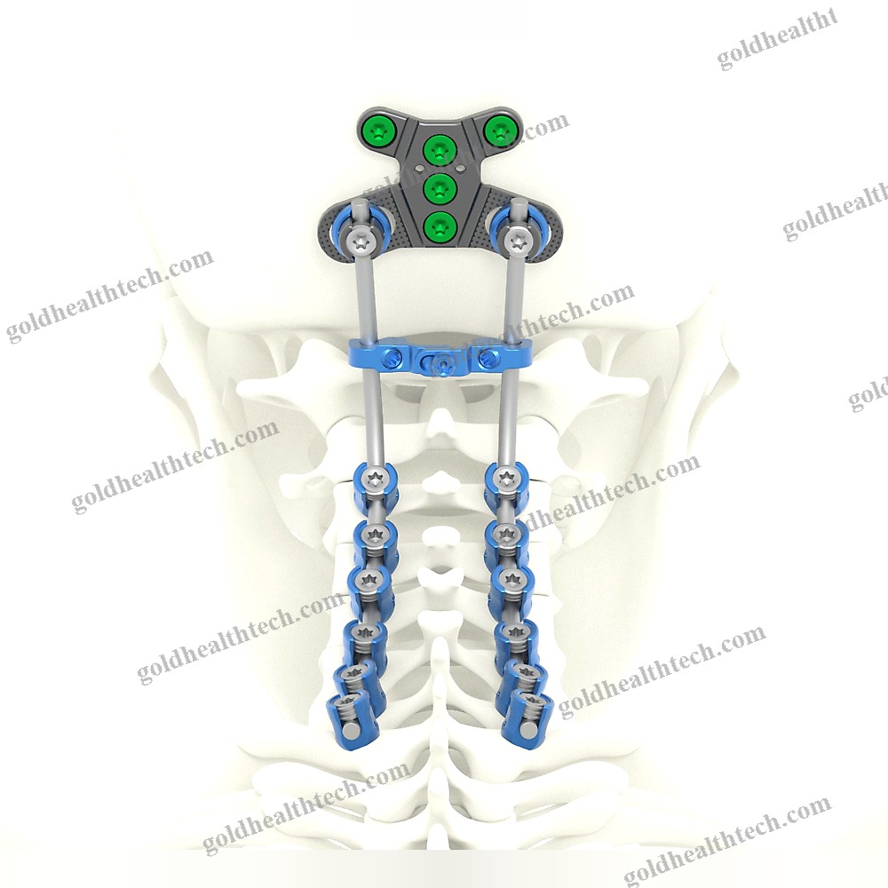Occipito-Cervico-Thoracic Osteosynthesis Unit