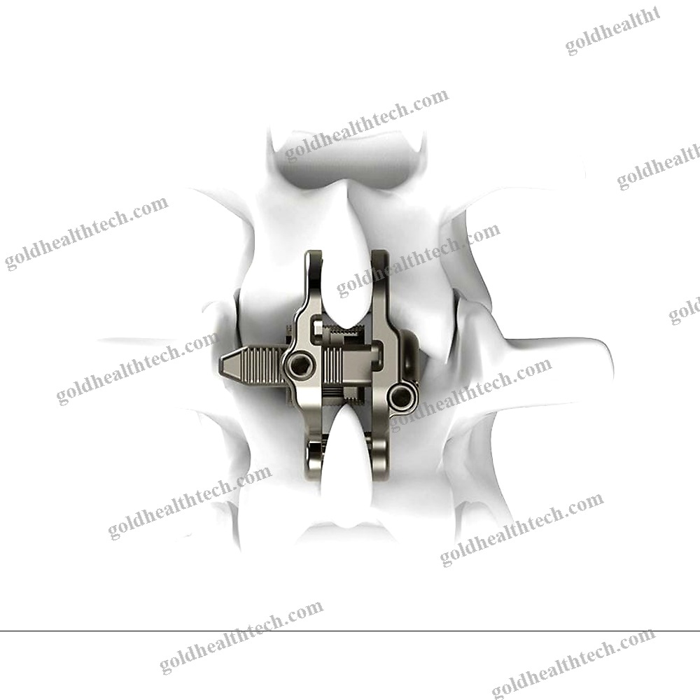 Lumbar Interspinous Vertebral Implant