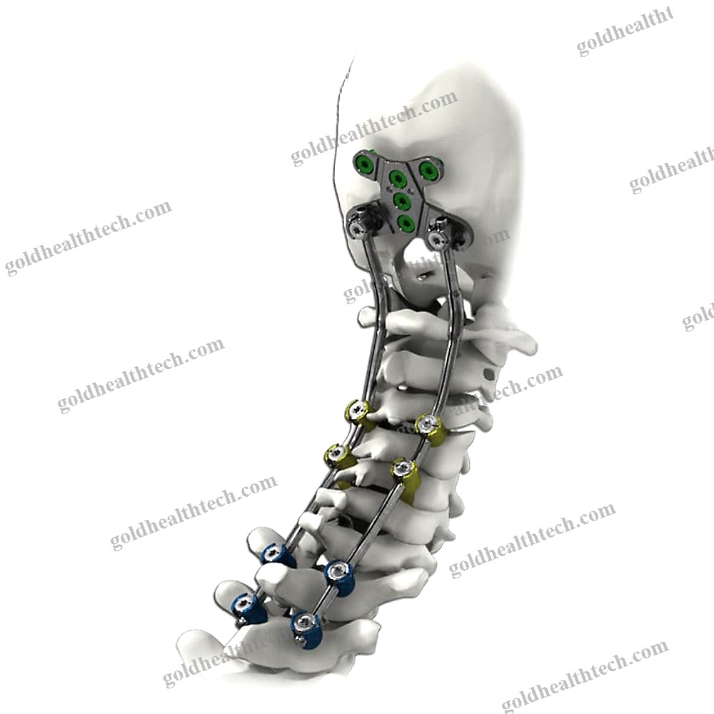 Occipito-Cervico-Thoracic Osteosynthesis Unit