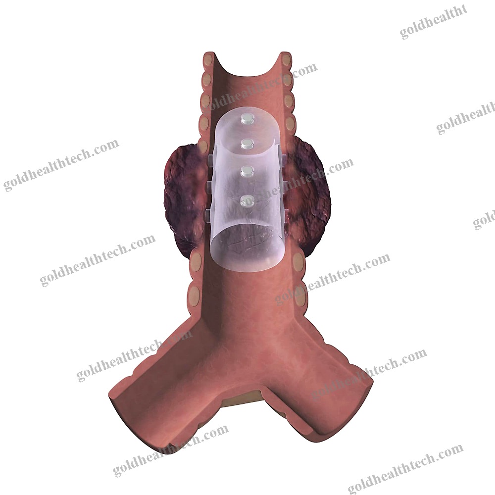 Bronchial Stent