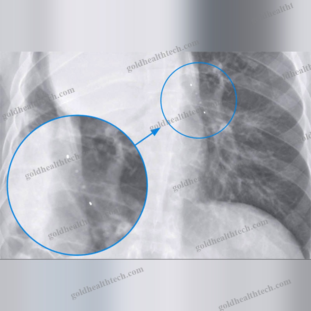 Bronchial Stent